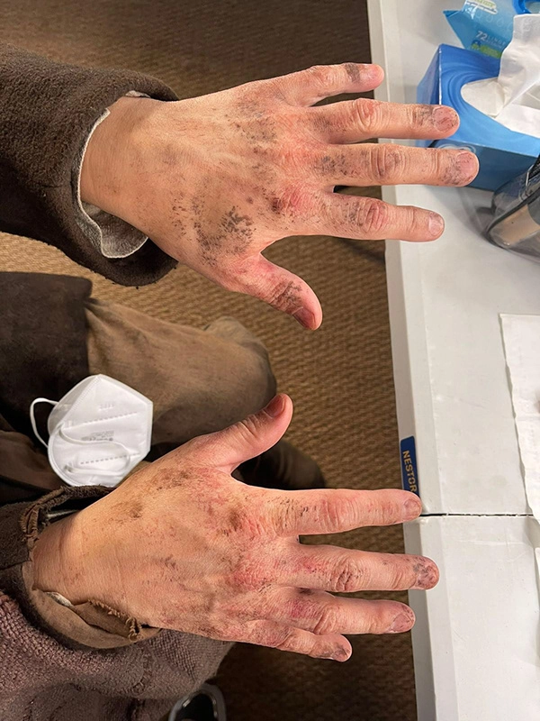 Justine Fiorito Hand dirt grime makeup for the film Les Trois Mousquetaires Justine Fiorito creating hand dirt/grime makeup for special effects on the set of *Les Trois Mousquetaires*.