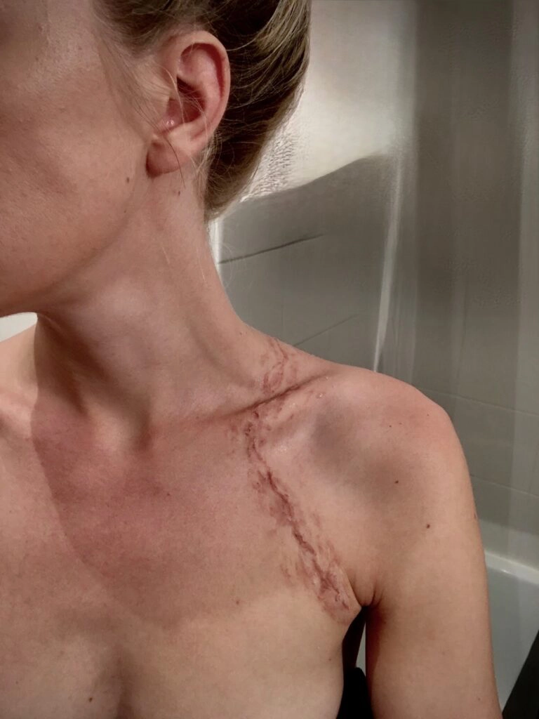 Justine Fiorito Maquillage effet spécial cicatrice réaliste pour tournage Maquillage effet spécial cicatrice réaliste réalisé par Justine Fiorito, maquilleuse professionnelle SFX