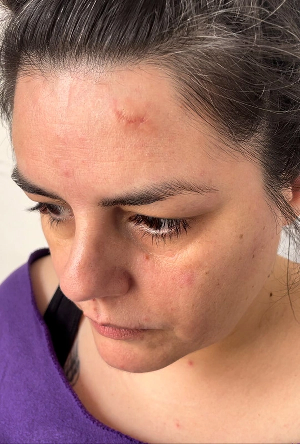 Justine Fiorito applying a prosthetic transfer to create a scar Justine Fiorito applying a prosthetic transfer to create a scar.