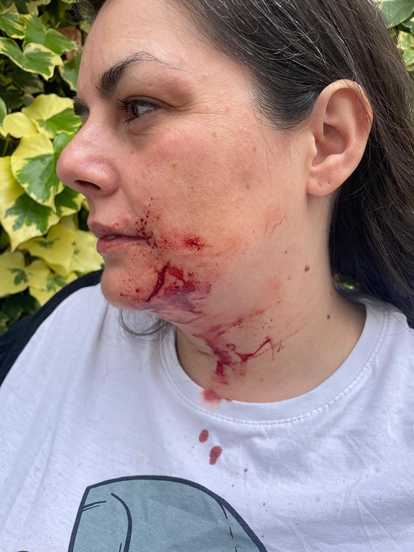 Justine Fiorito creating a bruised face makeup during her SFX2 training Justine Fiorito creating bruised face makeup during her SFX2 training.